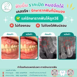 รักษารากฟัน โดยทันแพทยเฉพาะทางรักษารากฟัน อุบล